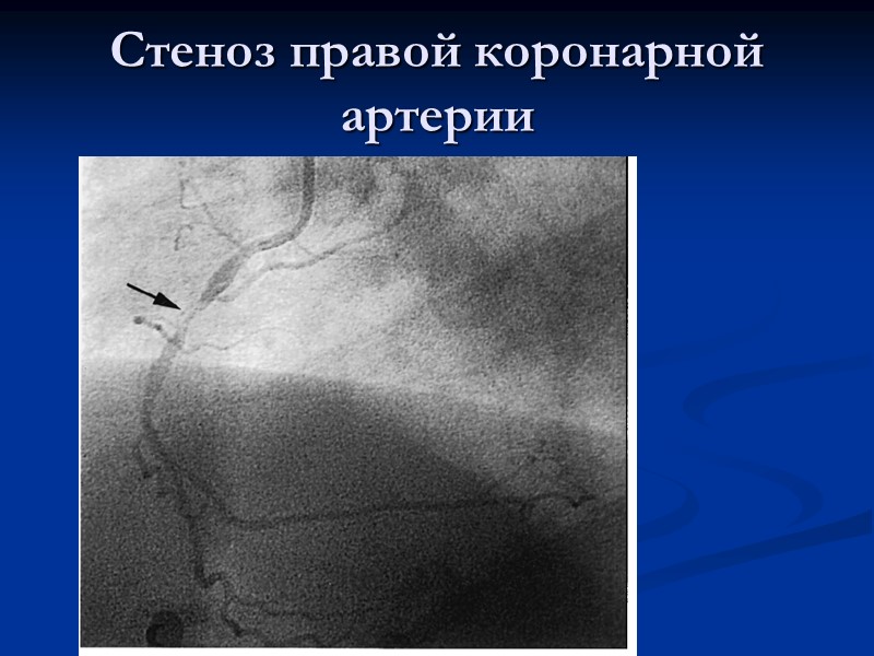 Стеноз правой коронарной артерии